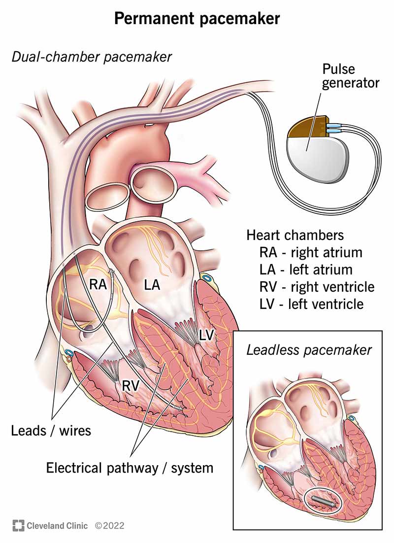Pacemaker Function: How It Works and Why It Matters