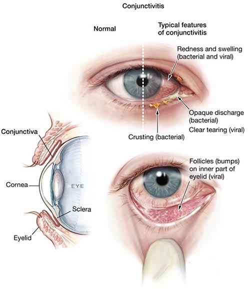 Pink Eye Diagnosis: Spot, Test & Treat Fast Quickly