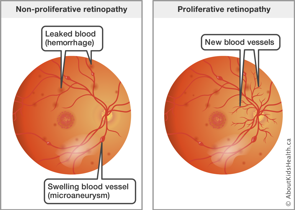 Proliferative Diabetic Retinopathy: Essential Guide