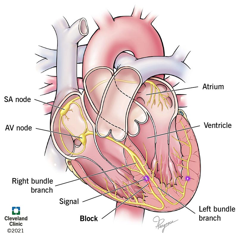 RBBB Treatment: Essential Guide to Care & Hope