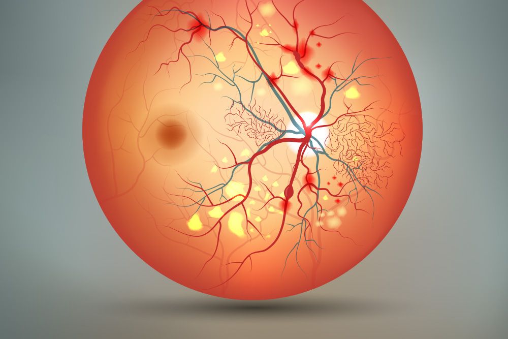 Retina Blood Vessel Damage: Risks & Treatments