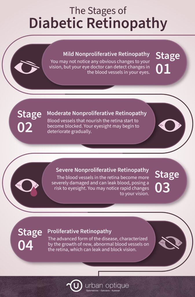 Retinopathy Stage Symptoms: What Diabetes Patients Need to Know