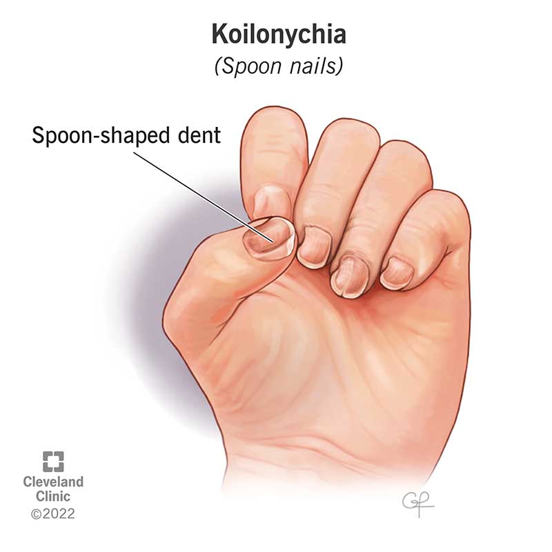 Spoon Nails Explained: Causes, Treatment & Quick Fixes
