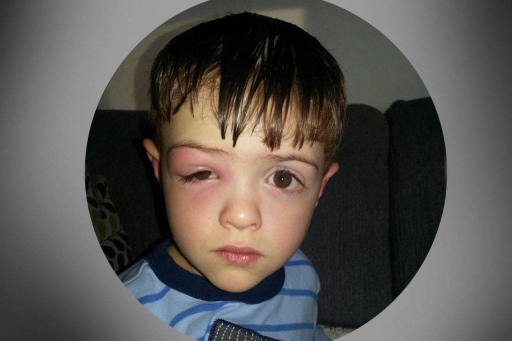 Toddler Eye Infection: Essential Guide for Parents