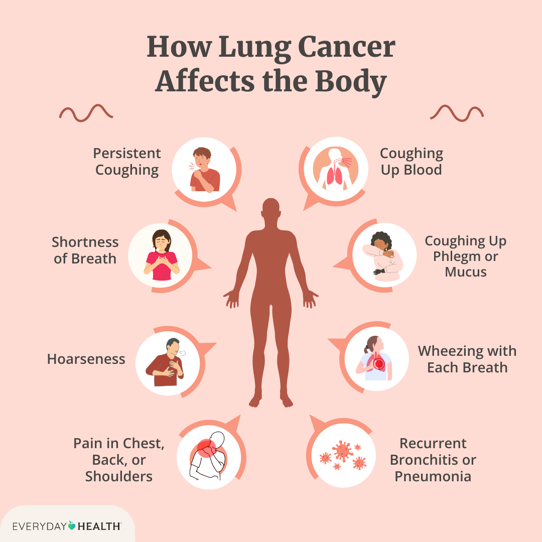 4 Symptoms of Lung Cancer That You Should Be Aware Of