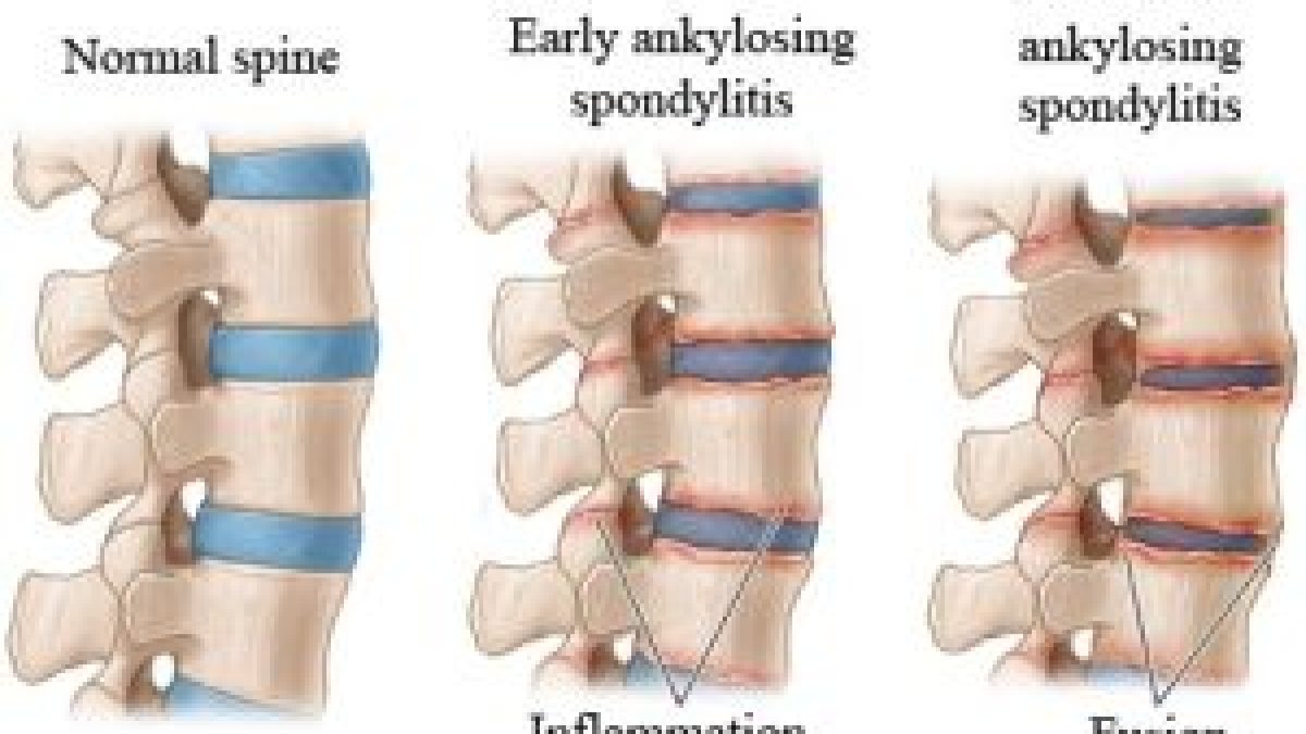 Ankylosing Spondylitis Reversal: What Really Works?