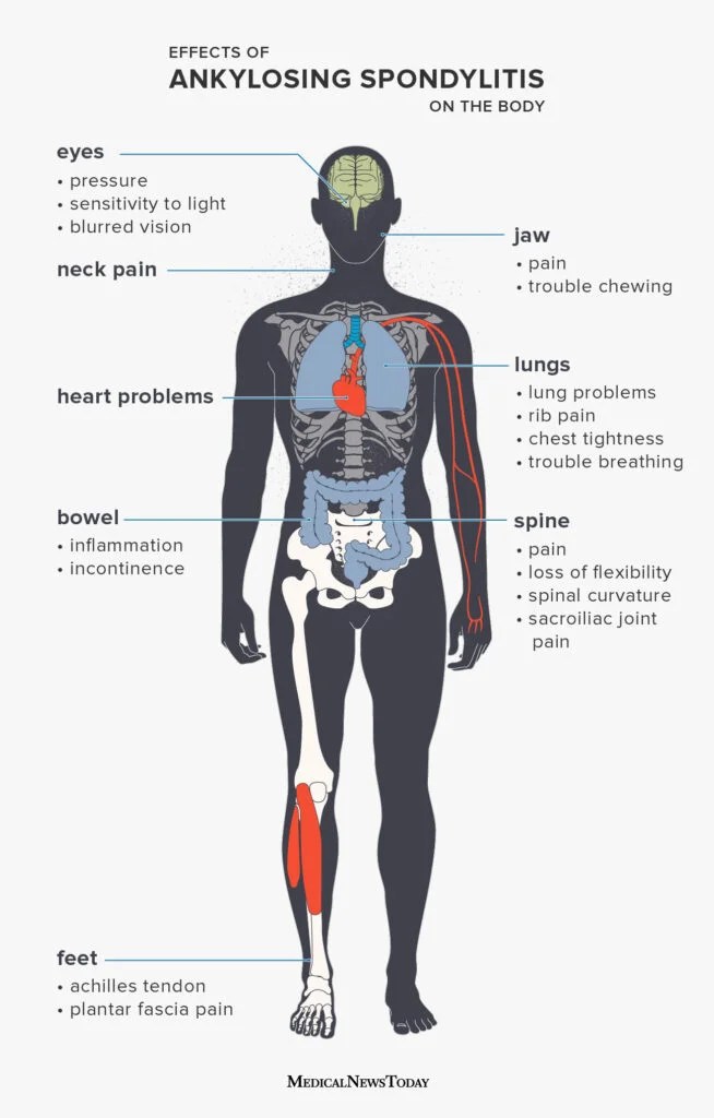 Can Ankylosing Spondylitis Be Reversed? Find the Truth