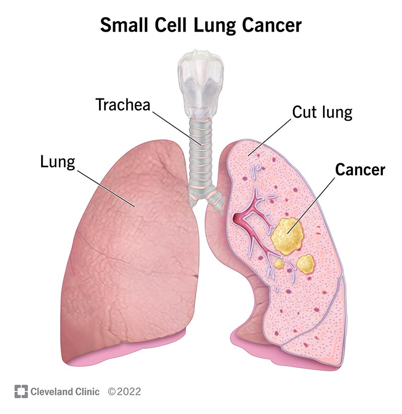 Has Anyone Beat Small Cell Lung Cancer? Survivors & Hope