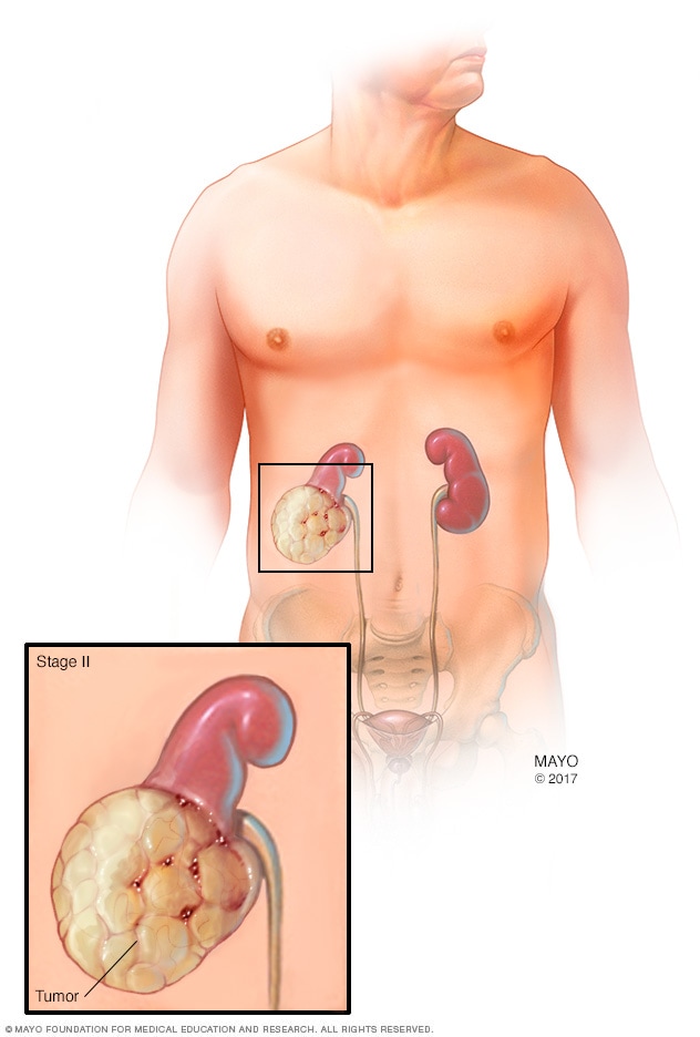 How to Shrink a Kidney Tumor: Real Options & Guidance