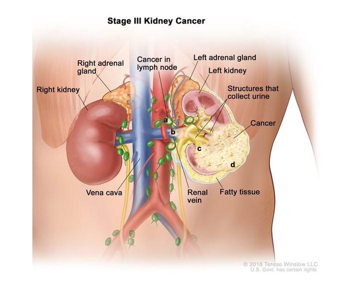 How to Starve Kidney Cancer: Proven Diet & Lifestyle