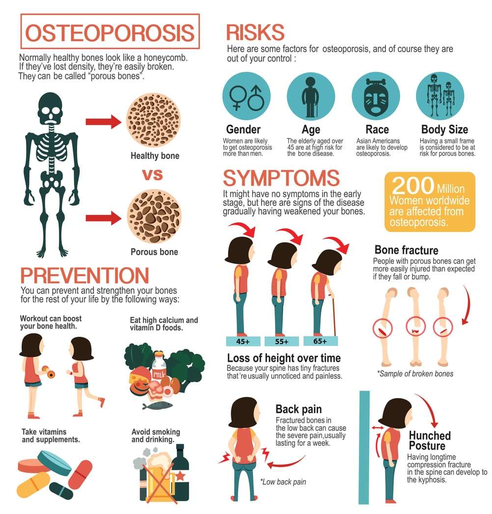 How to Treat Osteoporosis Without Medication