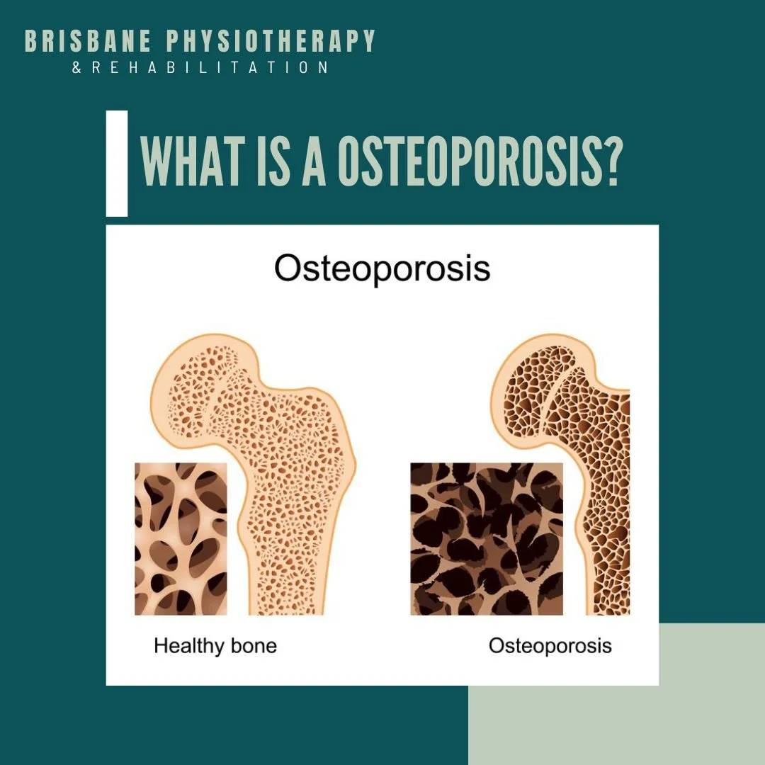 Osteoporosis Physiotherapy Management PPT: Helpful Guide