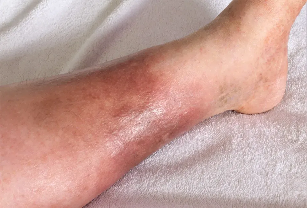 Pictures of Swollen Ankles in Congestive Heart Failure