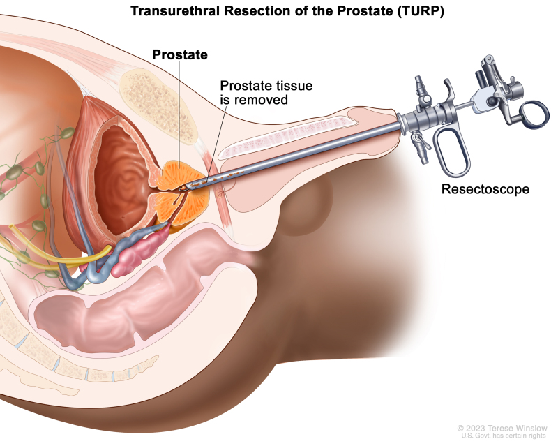 Prostate Cancer Treatment: Options, Success & Risks