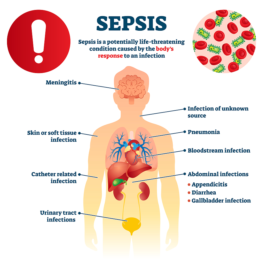 Sepsis End-of-Life Symptoms: What to Expect and Help