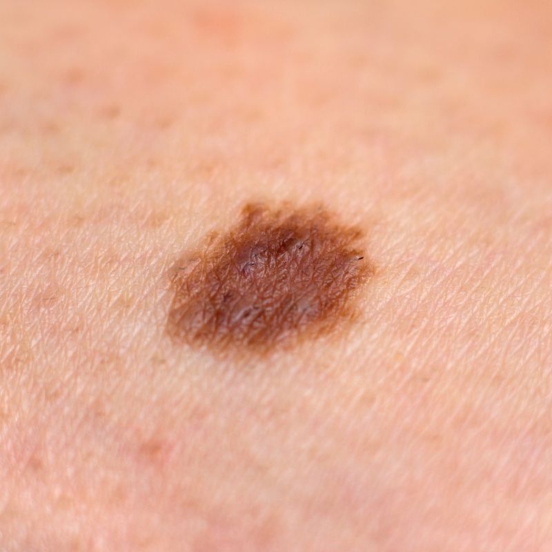 Skin Cancer Photos: Spot Early Signs & Stay Safe