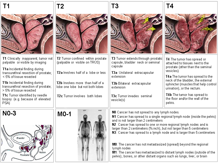Stage 5 Prostate Cancer Prognosis: Essential Facts