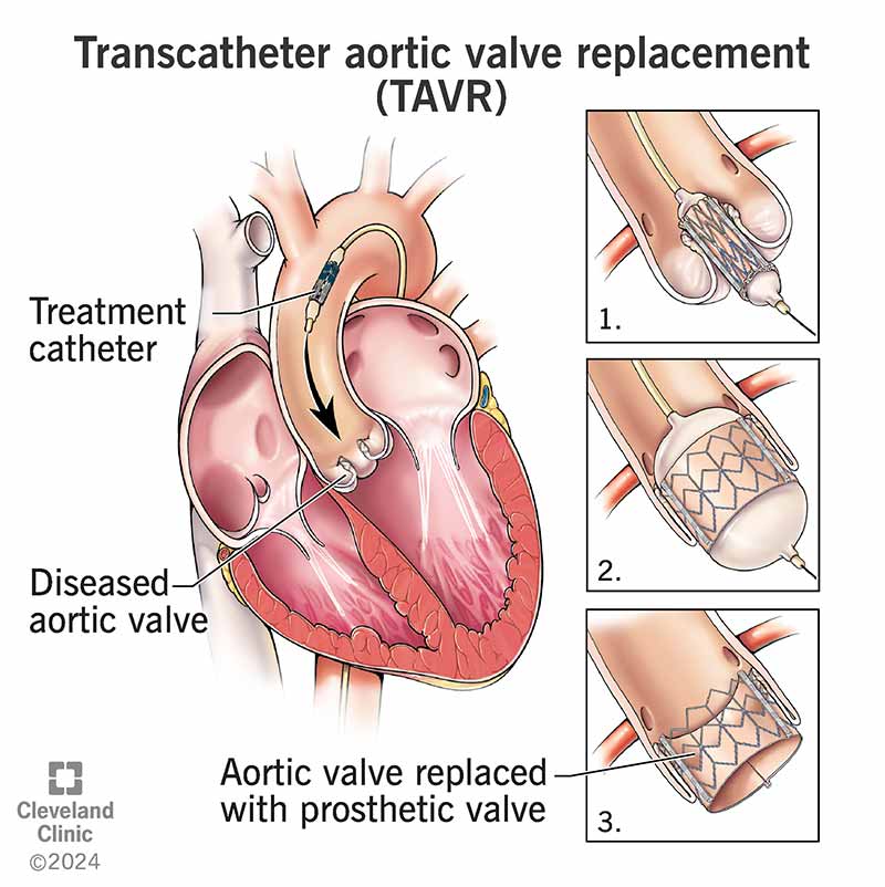 Transcatheter Aortic Valve Implantation: What You Need to Know