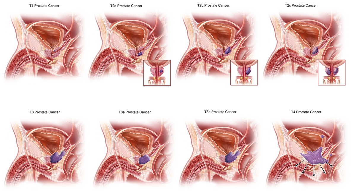 Types of Prostate Surgery: What’s Best for You?