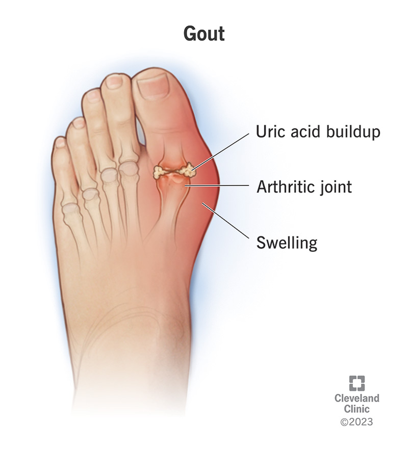 Uric Acid Symptoms: Spot Them Early & Manage Safely