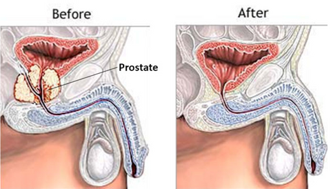 What to Expect After Prostate Is Removed – Guide