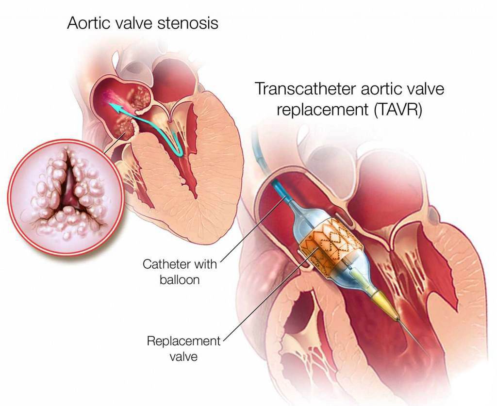 Which Is More Serious: Heart Bypass or Valve Replacement?
