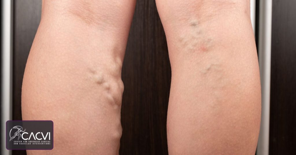Why is Only My Left Leg Swelling? Quick Guide