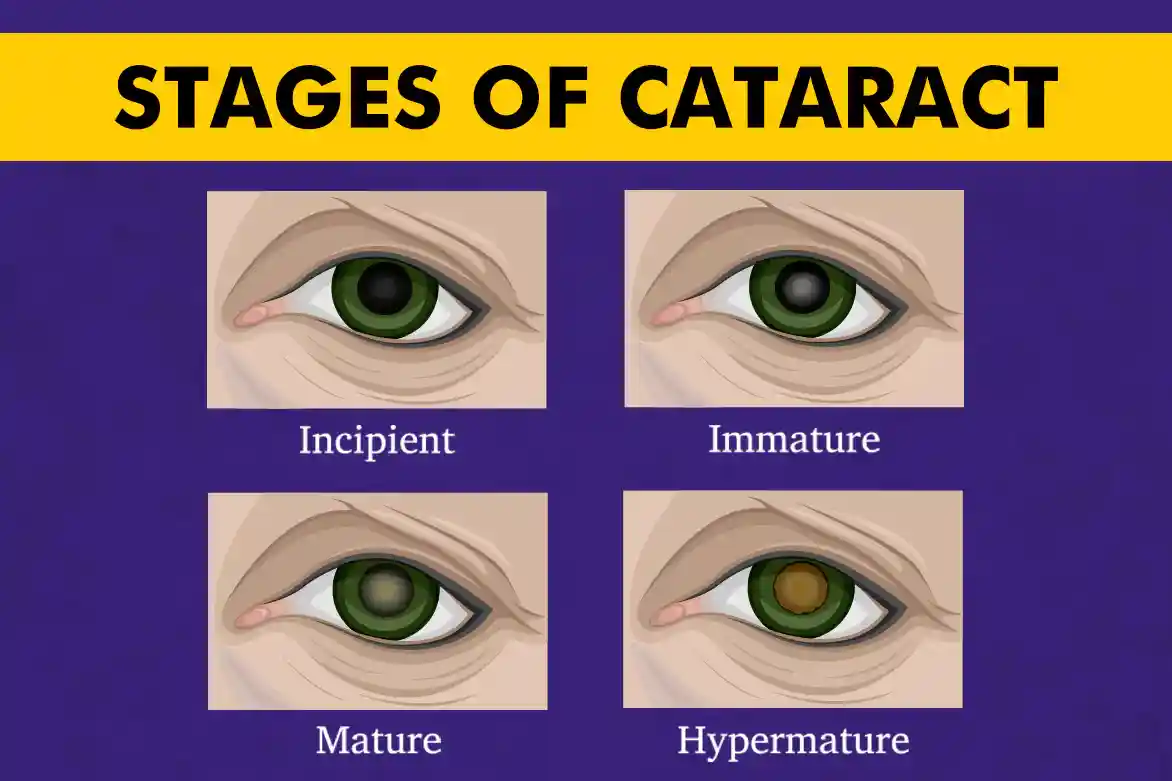 Cataract Eye Exam Findings – What Doctors Look For and Why It Matters