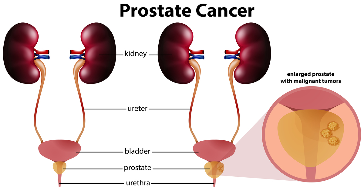 Dairy and Prostate Enlargement – What You Need to Know