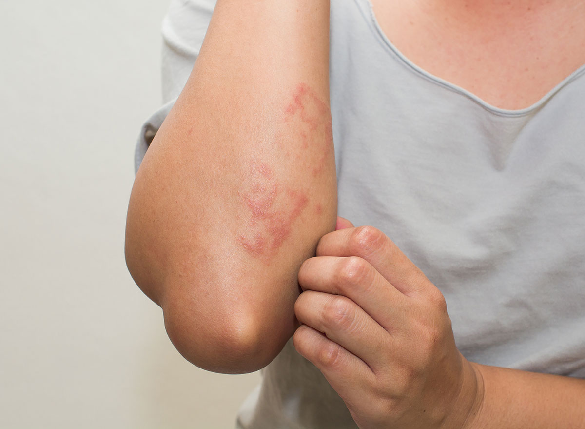 Gluten Withdrawal Itchy Skin: Causes & Relief Tips