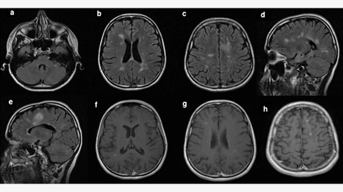 How Do Neurologists Diagnose Migraines? Simple Steps