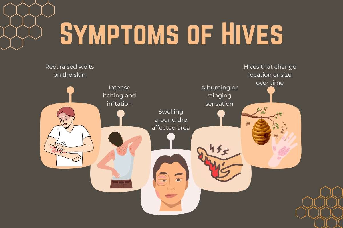 How to Cure Hives Fast – Quick Relief & Long‑Term Fixes