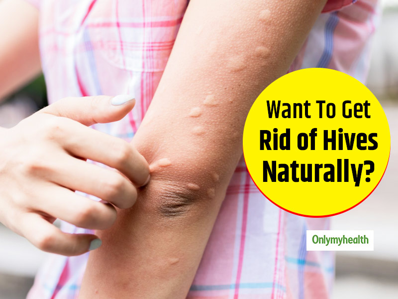 How to Stop Hives from Itching Fast
