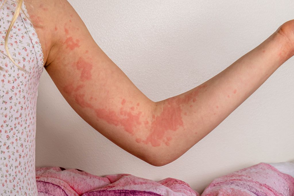 Pictures of Hives: Spot, Understand, and Treat Them Fast