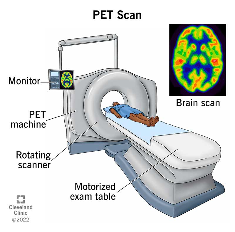 Prep for PET Scan for Cancer: Your Complete Guide