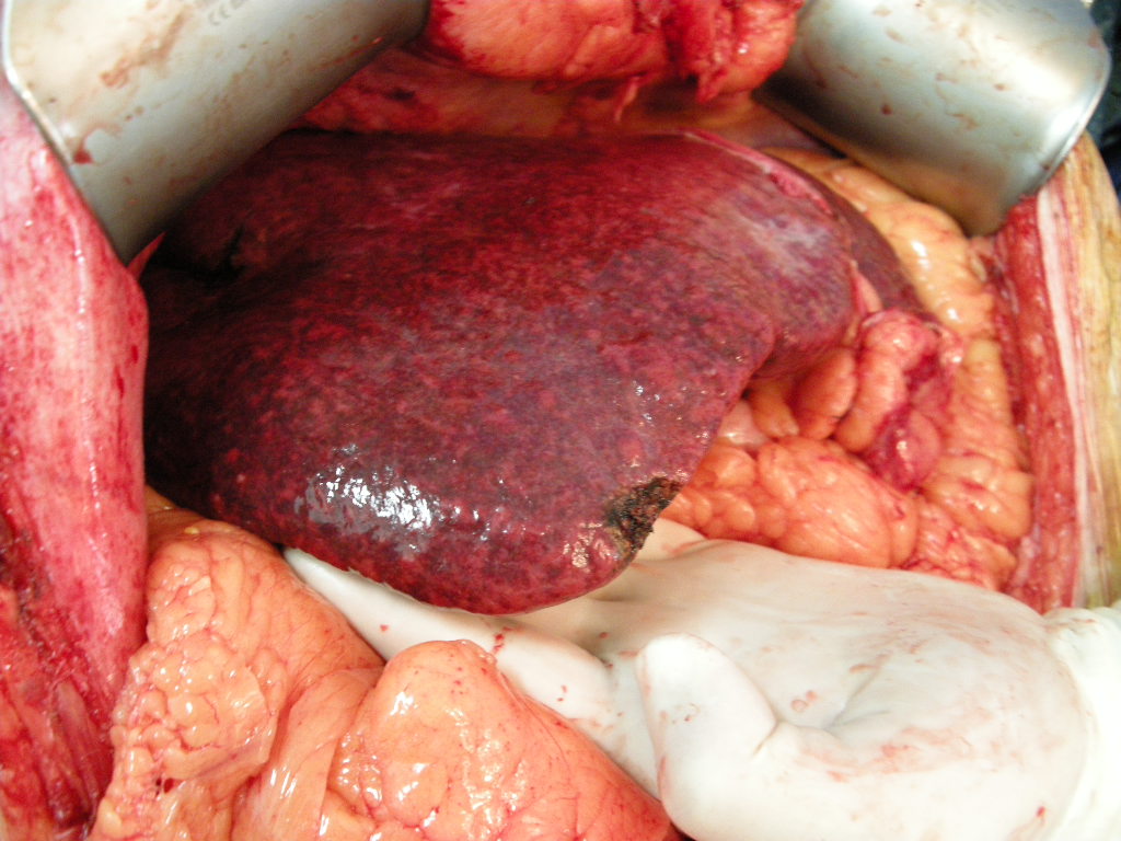 Repairing Liver Damage From Chemo: What Works