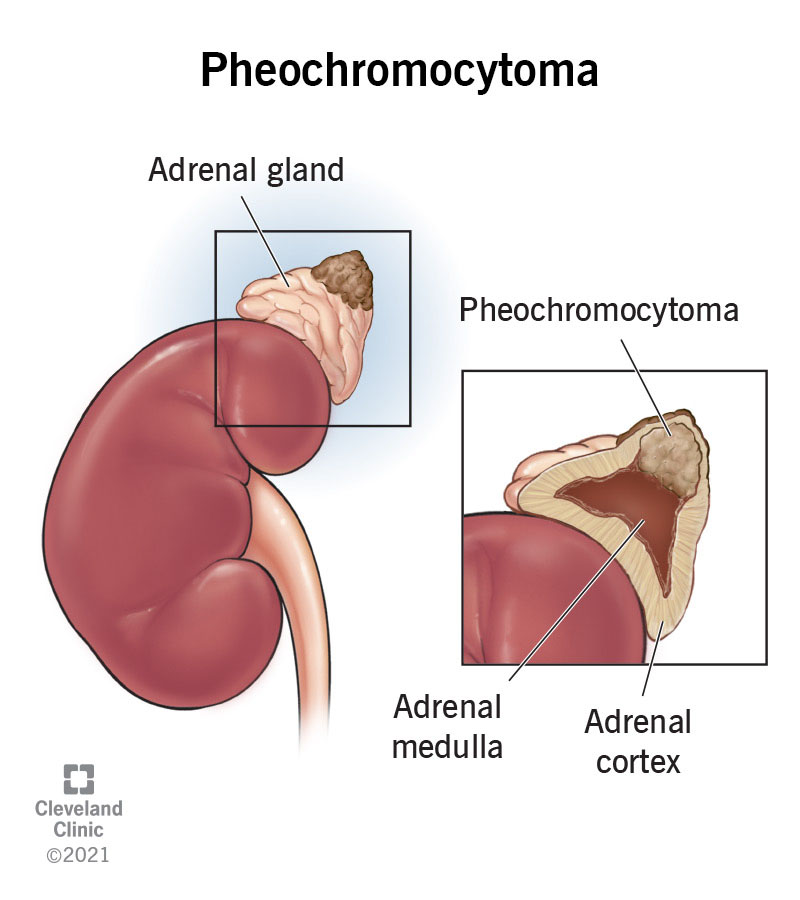 Should I Be Worried About a Nodule on My Adrenal Gland?
