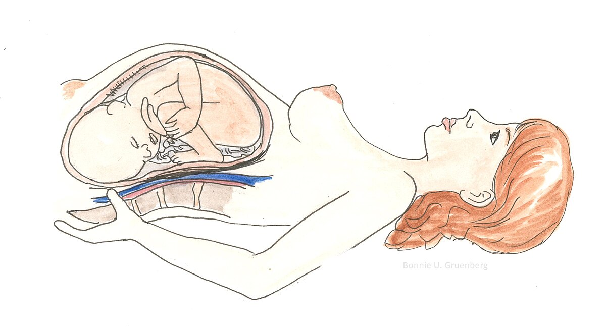 Supine Hypertension in Pregnancy: Essential Guide