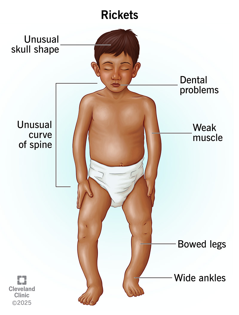 Symptoms of Calcium Deficiency in Child: Complete Guide
