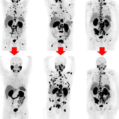 Time Between Chemotherapy and PET Scan: Key Facts