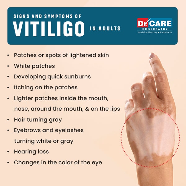 Vitiligo Causes and Prevention: What You Must Know
