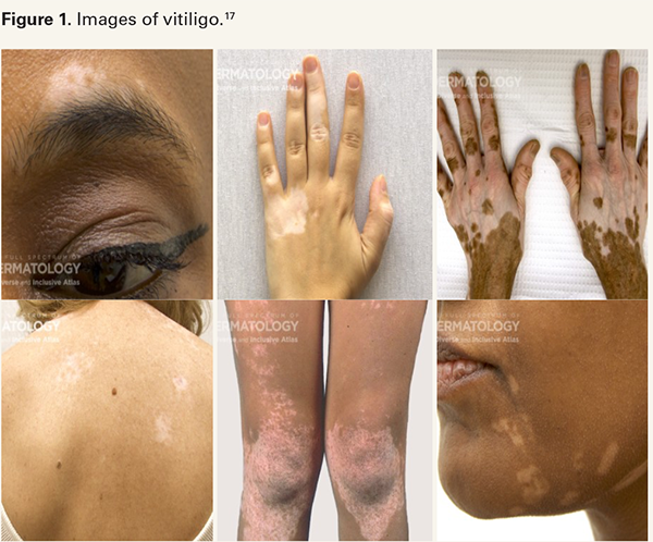 Vitiligo is Not an Autoimmune Disease – What That Means
