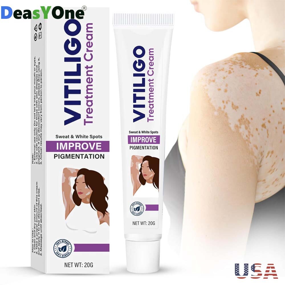 Vitiligo Treatment Cream: Best Options, Risks & Costs