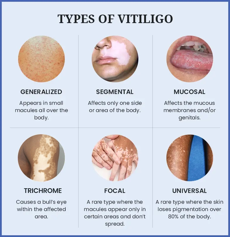 Vitiligo Treatment: Proven Options & How to Choose