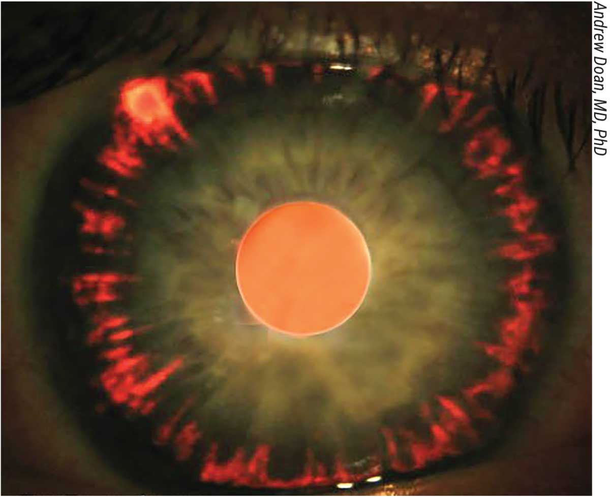 Best Treatment for Pigmentary Glaucoma: What Works