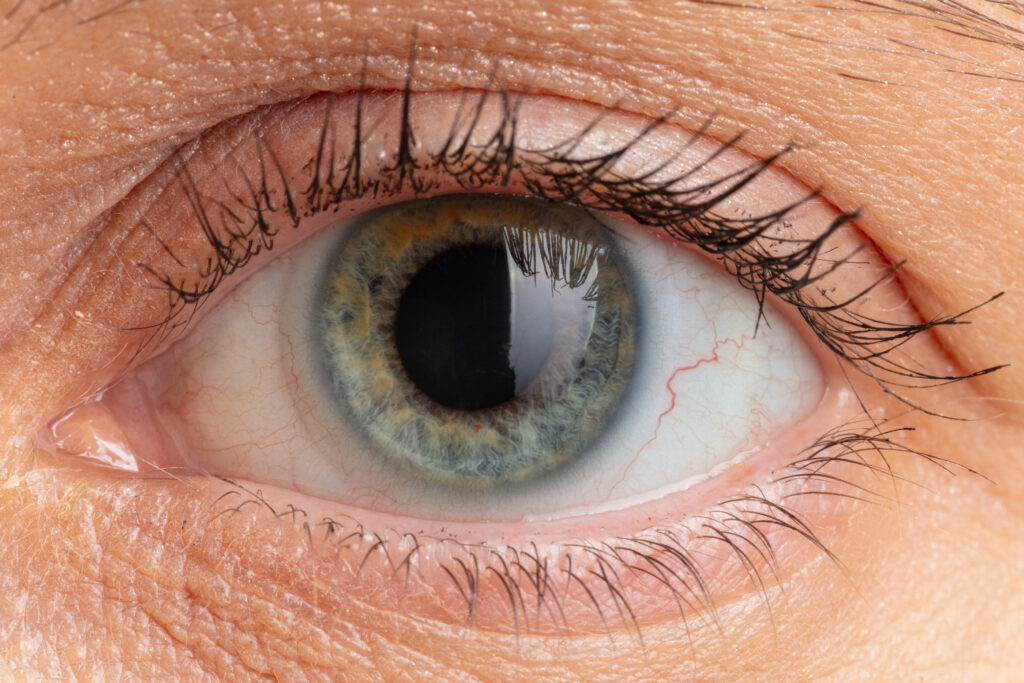 Can Neovascular Glaucoma Be Cured? Simple Answers