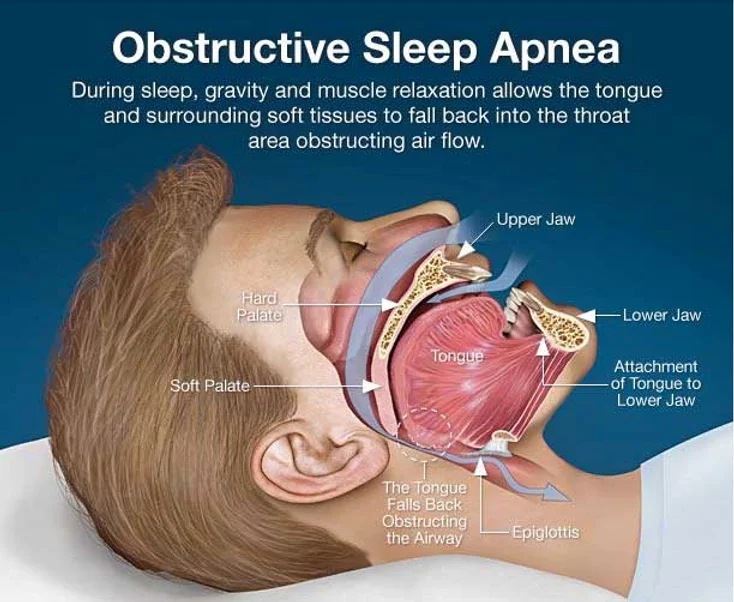Can Sleep Apnea Be Cured? The Truth You Need Finally