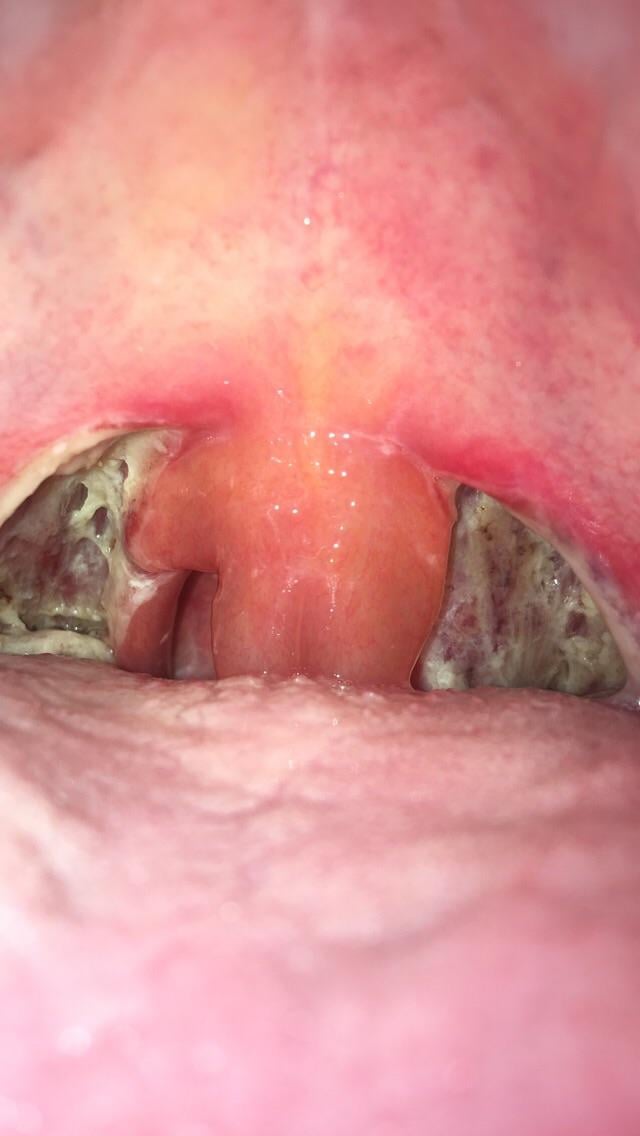 Can Your Uvula Grow Back After Removal? Find Out Here