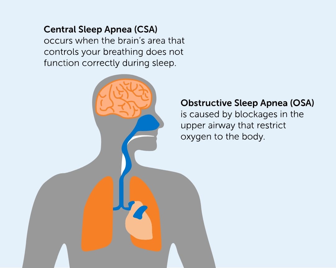 Why Central Sleep Apnea Happens: Key Causes & Treatment
