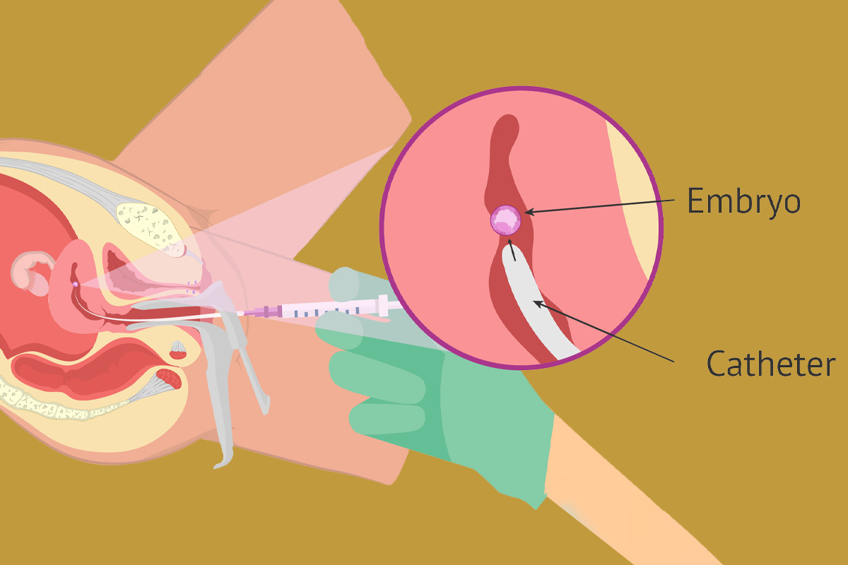 Constipation IVF Stimulation: What You Need to Know